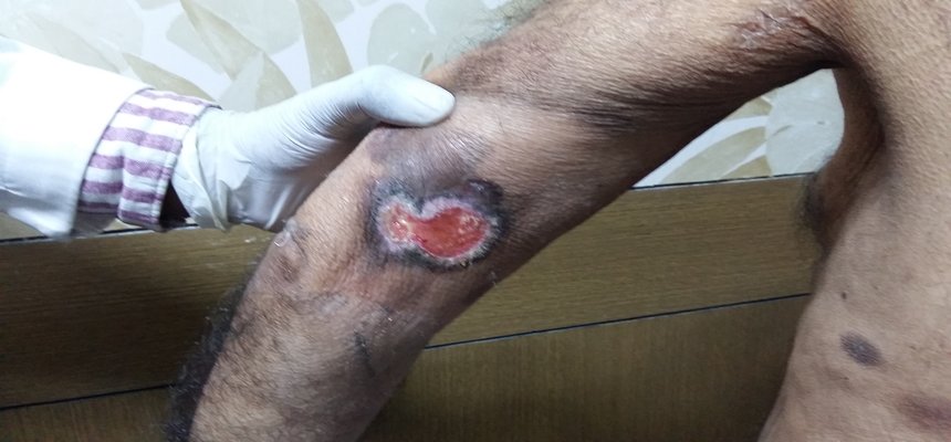 KIMS Radiation Oncologist successfully performs South Indiaâ€™s first Total Skin Electron Beam Radiation Therapy