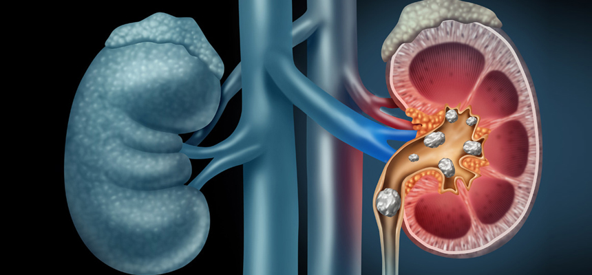 5 things you need to know about kidney stones