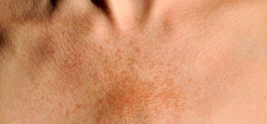 How to deal with Hyperpigmentation