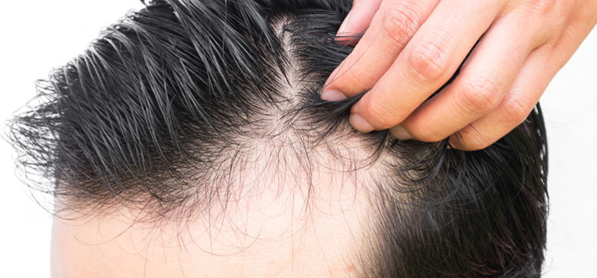 Hair Transplant is One of the safest cosmetic surgeries