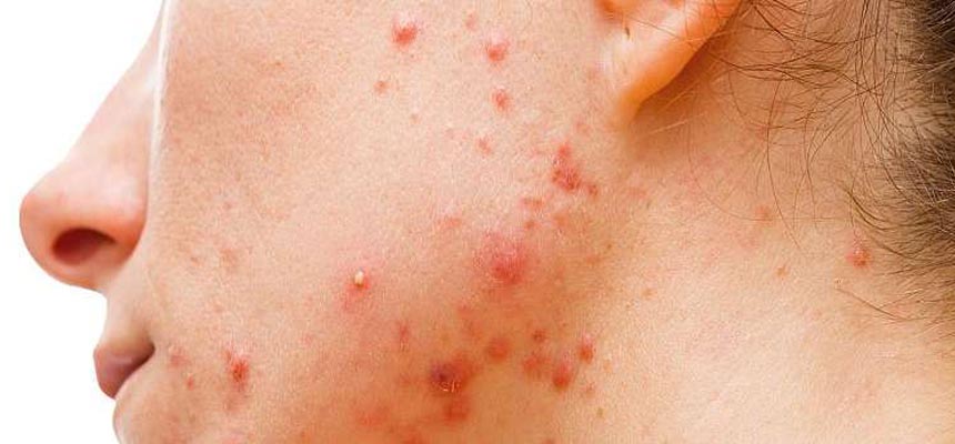 REASON FOR ACNE DURING THE MONSOON