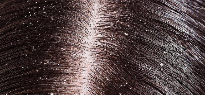 Get rid of unwanted Dandruff easily