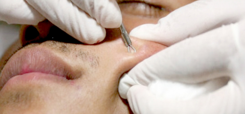 How To Treat Blackheads 