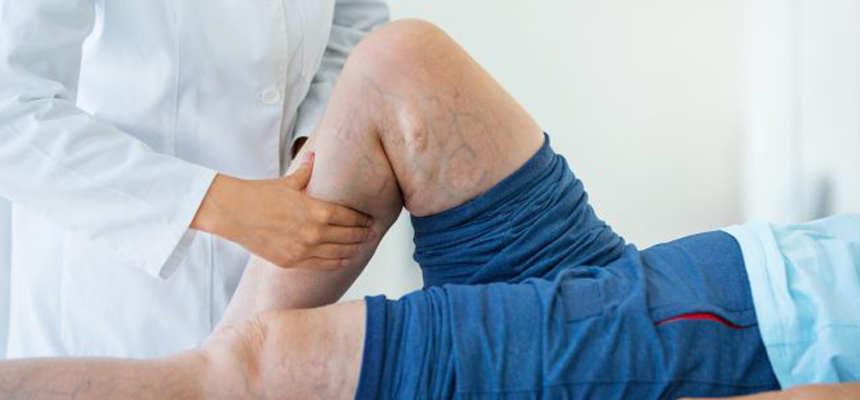 What we need to know about Varicose Veins