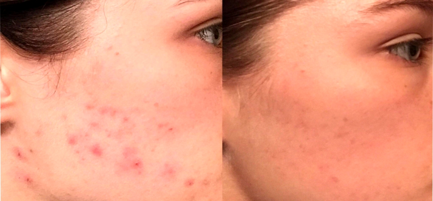 Worst Skin Advice you need to avoid