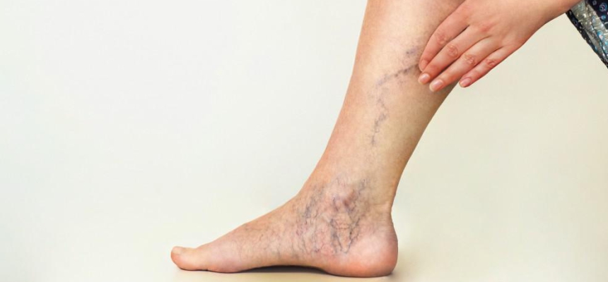 Winter is the right time to treat Varicose Veins