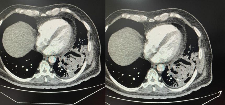 Doctors at SLG Hospitals remove Black and White Fungus ball from Lungs to save life of a 60 years old man