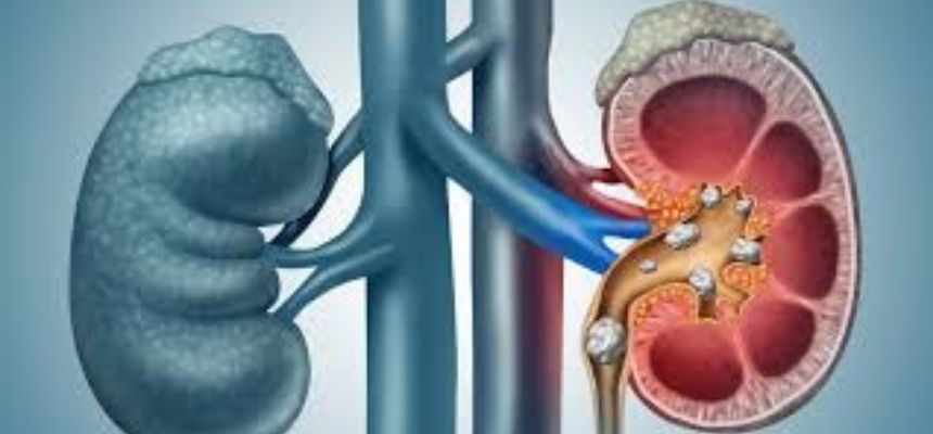 IS IT TRUE THAT SURGERY IS THE ONLY WAY TO TREAT KIDNEY STONES