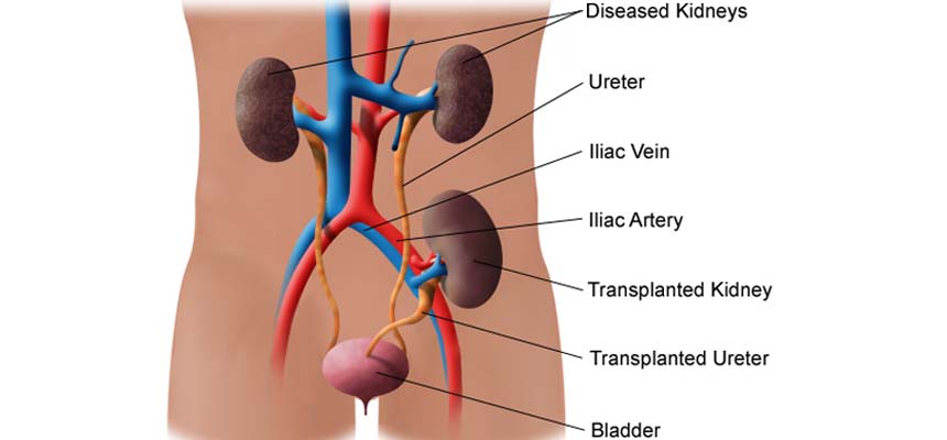Plasmapharesis â€“ new method for kidney transplant 