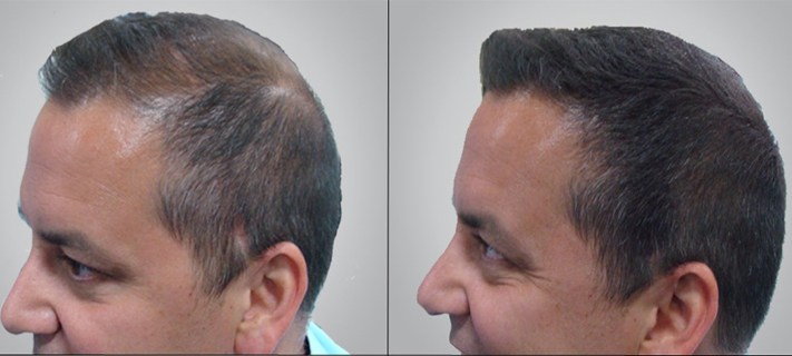 Apollo Spectra Hospitals, Doctor Invents Injection for Natural Hair Re-growth, bags US Patent