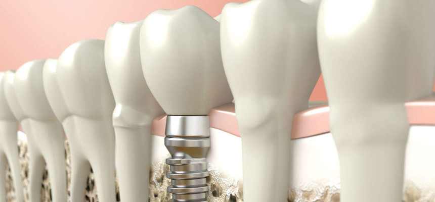 Importance of Dental Implants
