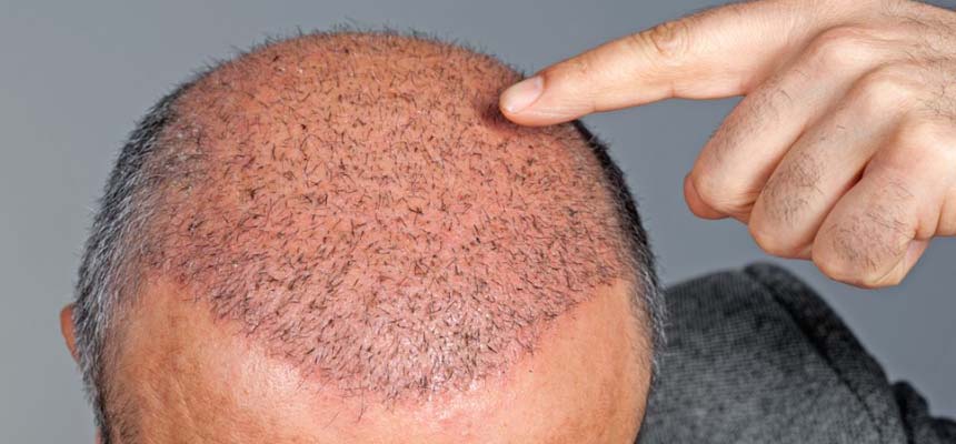 Hair Transplant â€“ the cosmetic transformation 