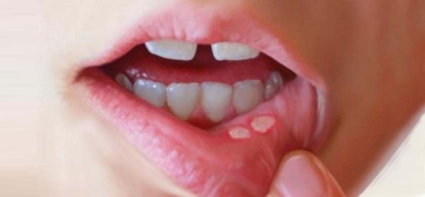 A non-healing ulcer for more than 2 weeks - get it checked 