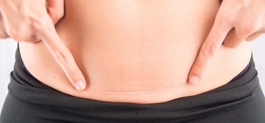 A steady ascent of C- section operations