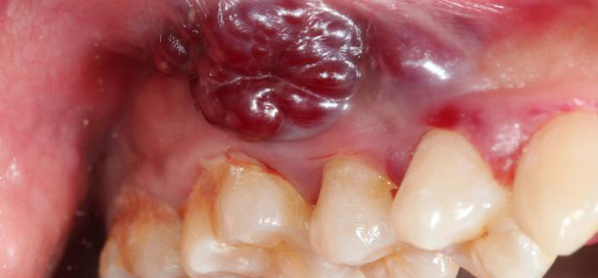 World No Tobacco Day - Oral Cancer