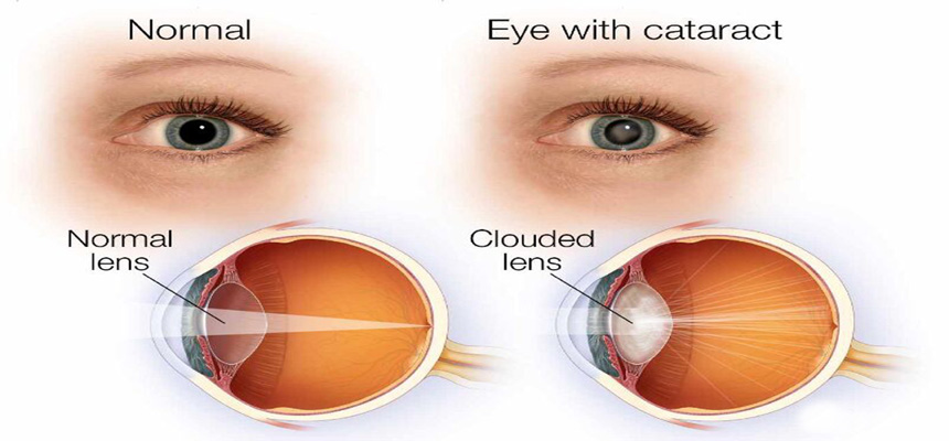 Are Indians at a higher risk of getting cataracts?