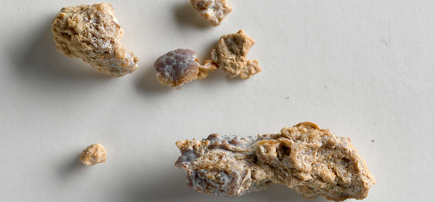 A Comprehensive Understanding of Kidney Stones