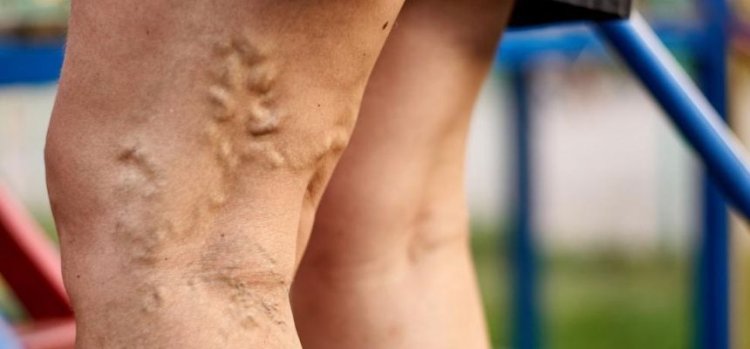 VARICOSE VEINS A GUIDE TO UNDERSTANDING AND PREVENTING THEM