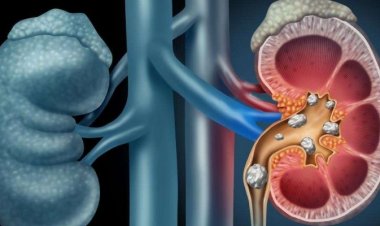 WHY DO MORE PEOPLE GET KIDNEY STONES IN THE SUMMER