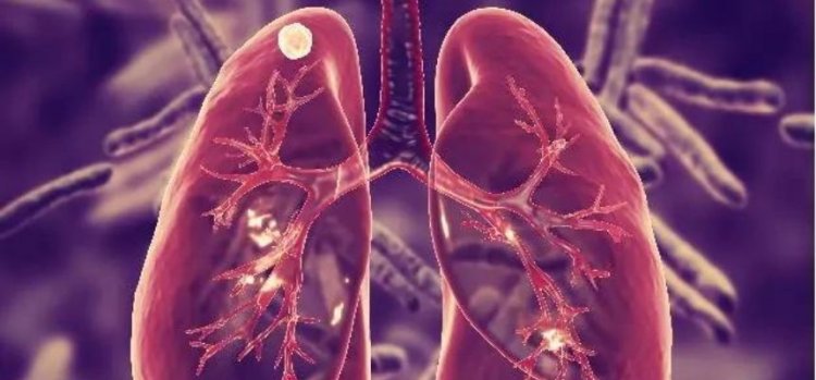 STAY SAFE FROM THE FATAL TUBERCULOSIS