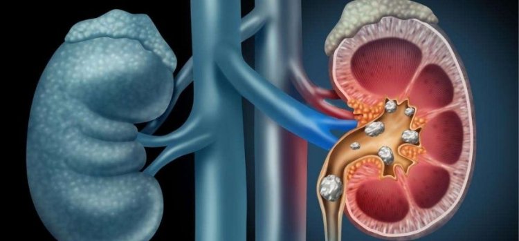 WHY DO MORE PEOPLE GET KIDNEY STONES IN THE SUMMER