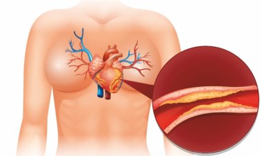 CORONARY ARTERY DISEASE