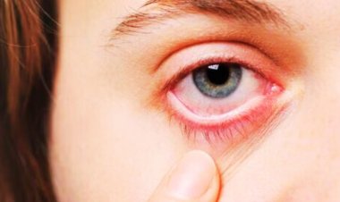 A Nationwide Upsurge in Pink Eye Conjunctivitis Cases, especially Follicular Conjunctivitis