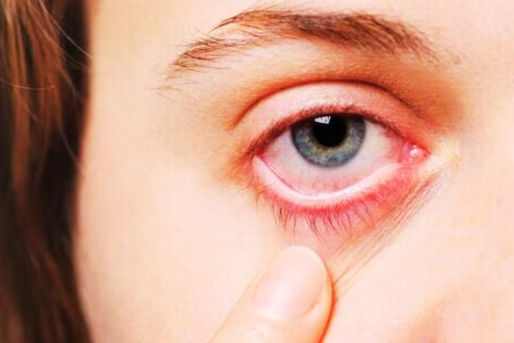 A Nationwide Upsurge in Pink Eye Conjunctivitis Cases, especially Follicular Conjunctivitis