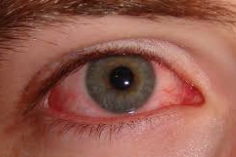 CONTAIN guidelines to contain VIRAL CONJUNCTIVITIS (PINK EYE)