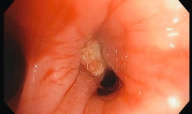 Hyderabad's Star Hospitals Extracts a Groundnut from a 71-Year-Old Patient's Lung.