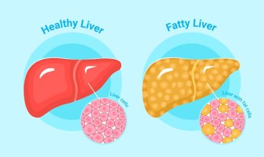 Understanding and Managing Fatty Liver Disease by  Dr. Golamari Srinivasa Reddy