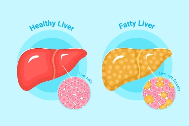Understanding and Managing Fatty Liver Disease by  Dr. Golamari Srinivasa Reddy