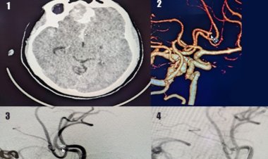 Aneurysm: Understanding the Silent Threat and Taking Preventive Measures