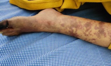 The Silent Killers: Understanding and Combating Vascular Diseases