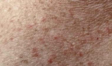 Things you need to know about Post-COVID Skin Issues