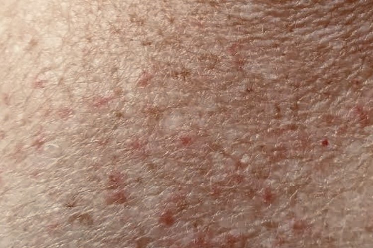 Things you need to know about Post-COVID Skin Issues
