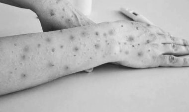 Prevention and Precautions against for M Pox
