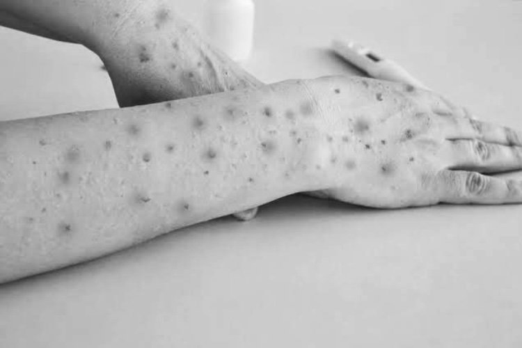Prevention and Precautions against for M Pox
