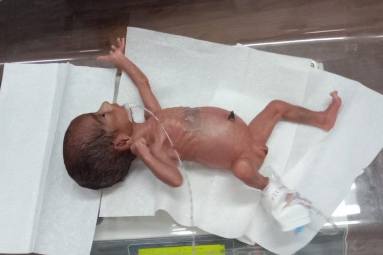 Apollo Cradle gives extreme preterm baby a fighting chance: A case of hope and resilience
